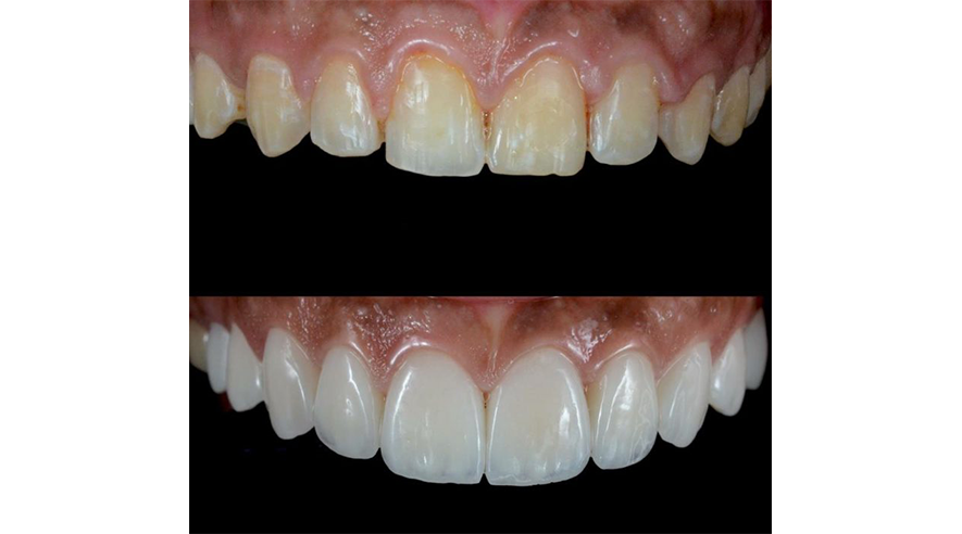 before and after of white teeth