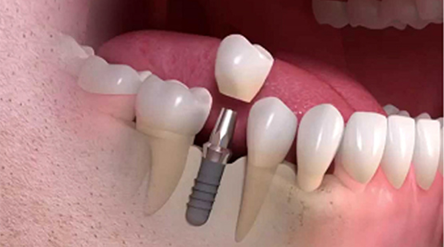 dental immediate implant