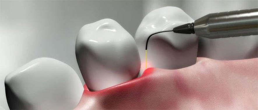 dental lanap therapy